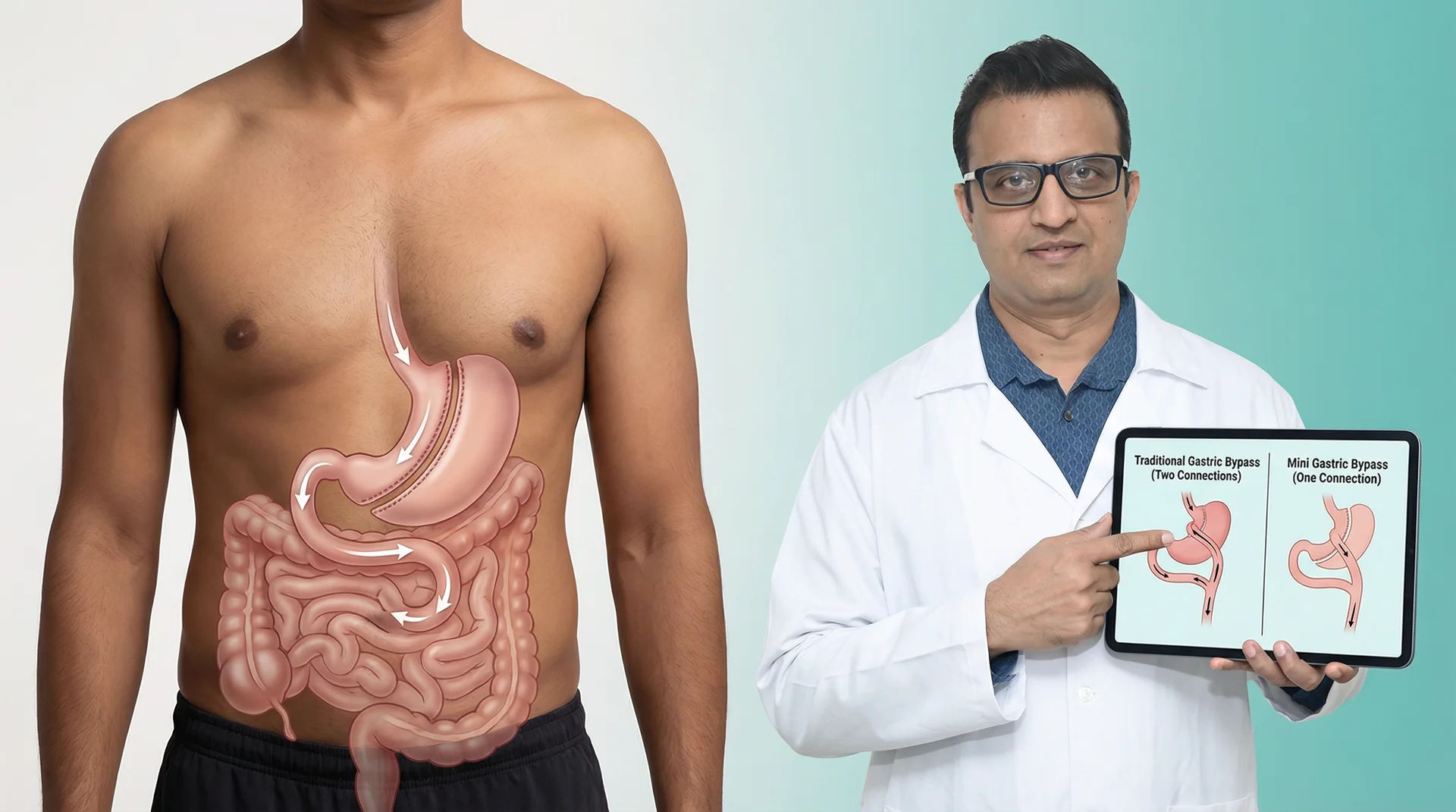 Laparoscopic One Anastomosis Gastric Bypass (OAGB)